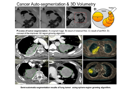 Cancer Auto-segmentation & 3D Volumrtry