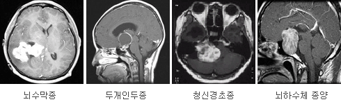 뇌수막종 / 두개인두종 / 청신경초종 / 뇌하수체 종양