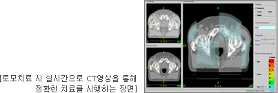 토모치료 시 실시간으로 CT 영상을 통해 정확한 치료를 시행하는 장면