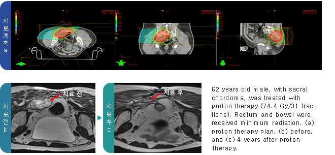 62 years old male, with sacral chordoma, was treated with proton therapy (74.4 Gy/31 fractions). Rectum and bowel were received minimum radiation. (a) proton therapy plan, (b) before, and (c) 4 years after proton therapy.