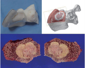 개인 맞춤형 골종양 수술, 3D 프린팅으로 정밀도와 안정성 높여